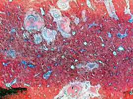 Plural abscesses