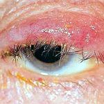 Ophthalmia – a description of the disease