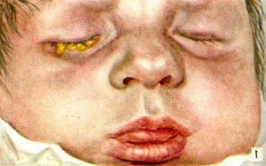 Treatment of neonatal ophthalmia